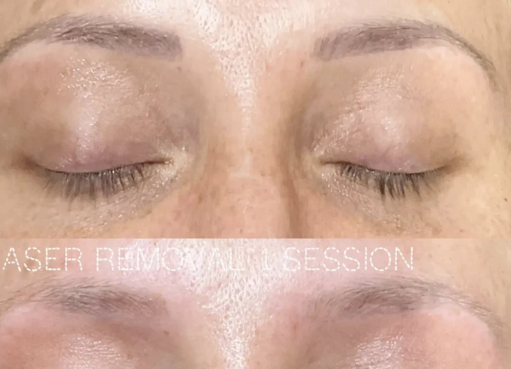 How Many Sessions Do You Need for Eyebrow Tattoo Removal