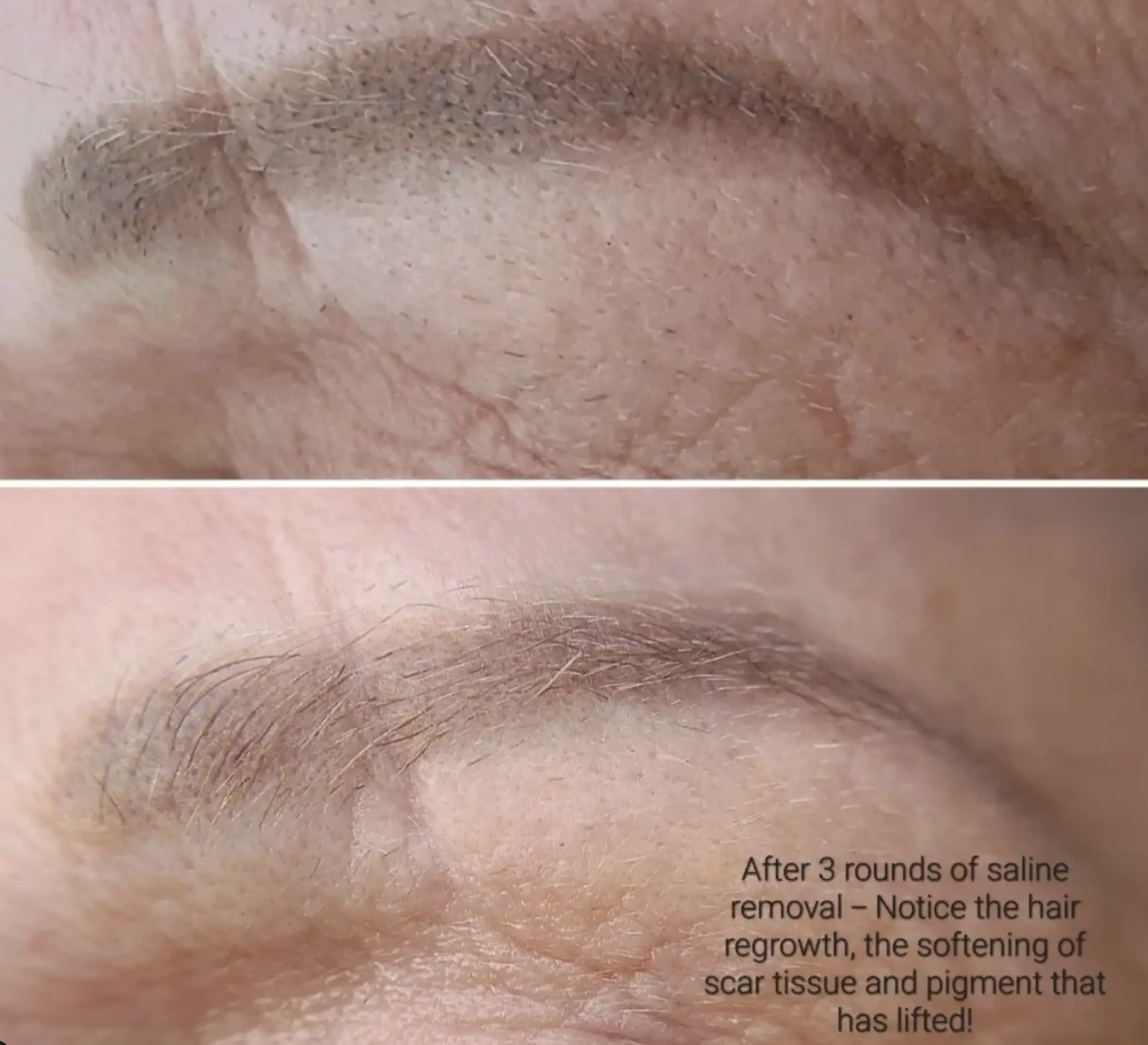 eyebrow tattoo removal Melbourne