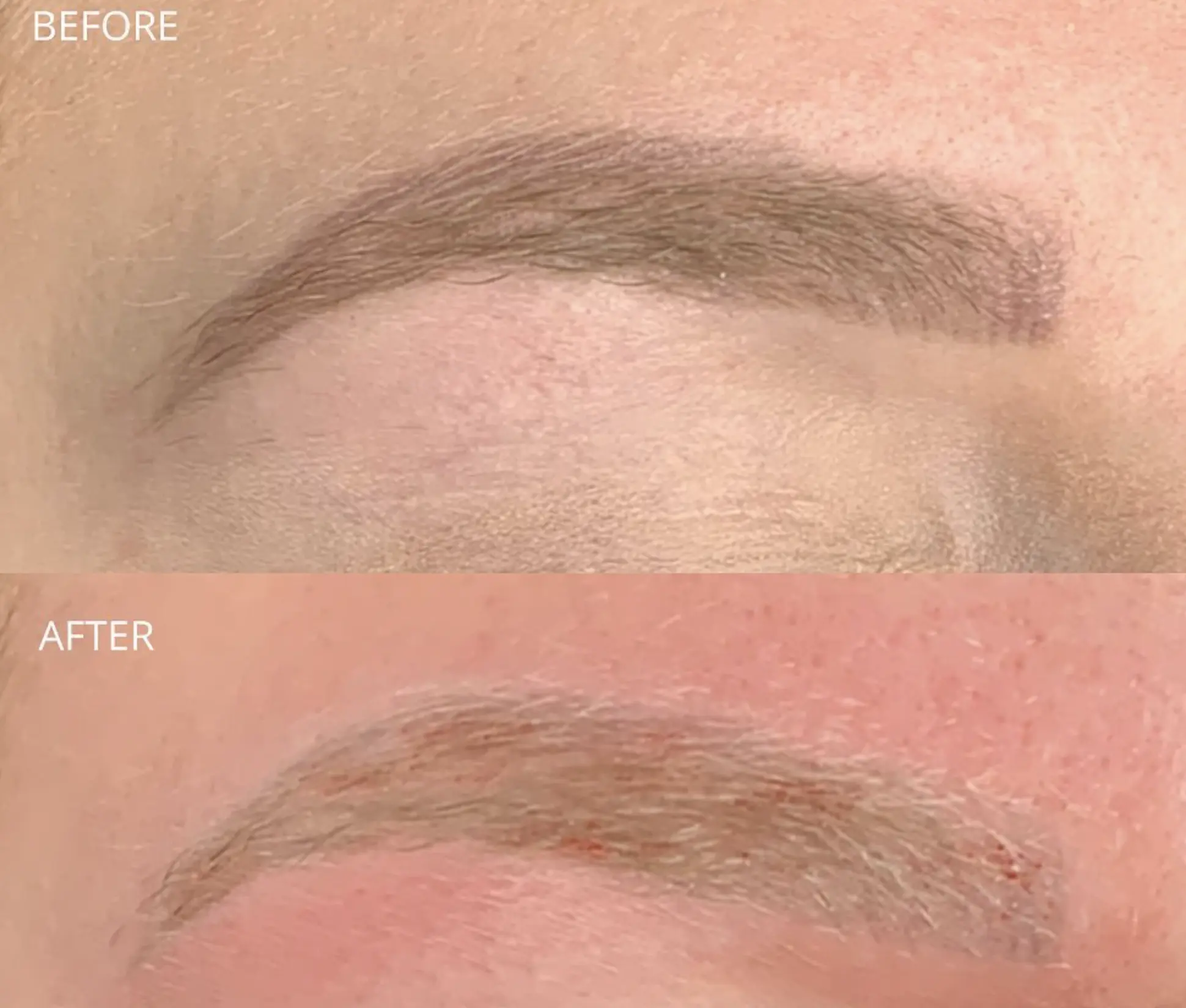 how many sessions for eyebrow tattoo removal