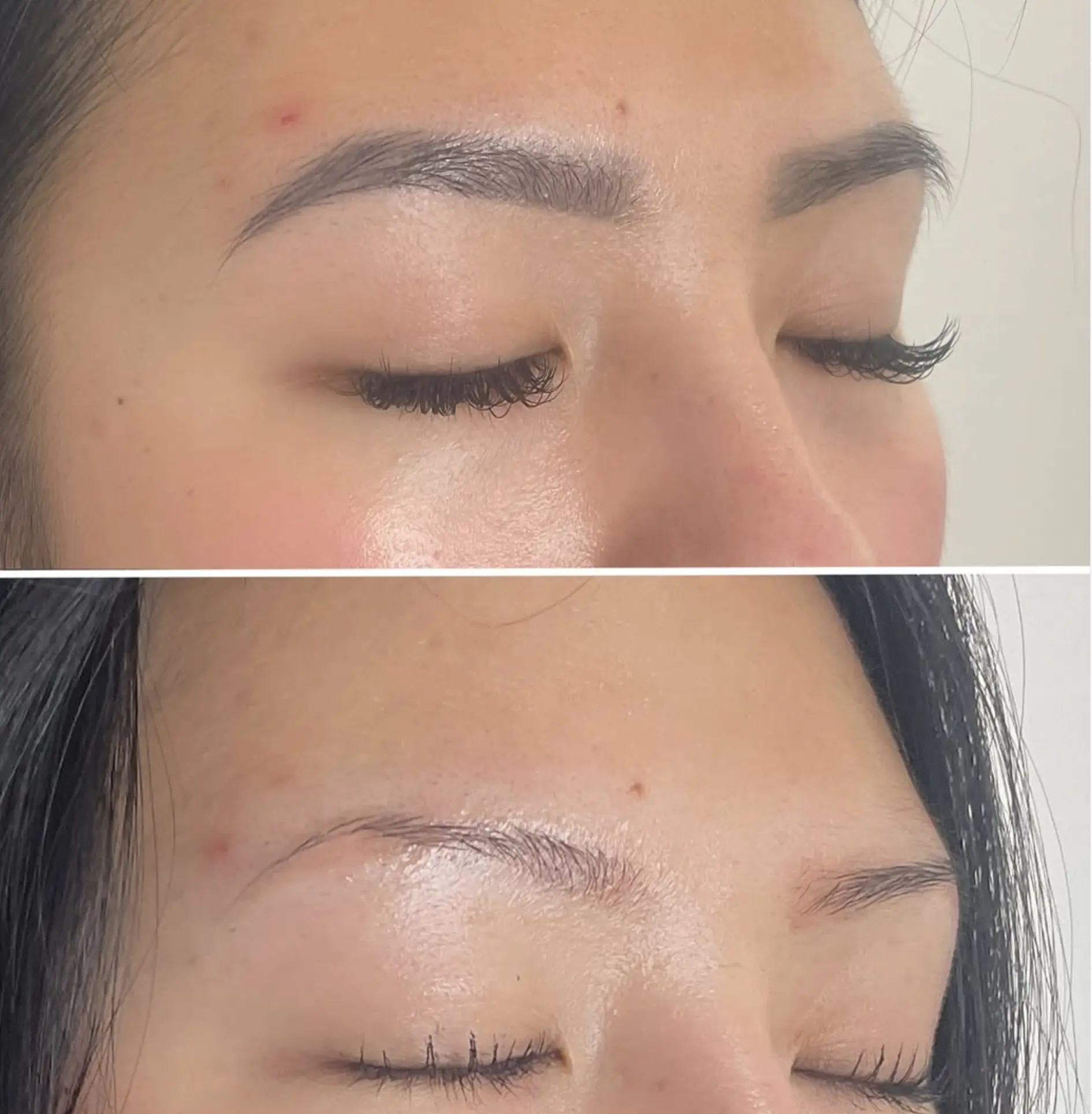 microblading removal Melbourne