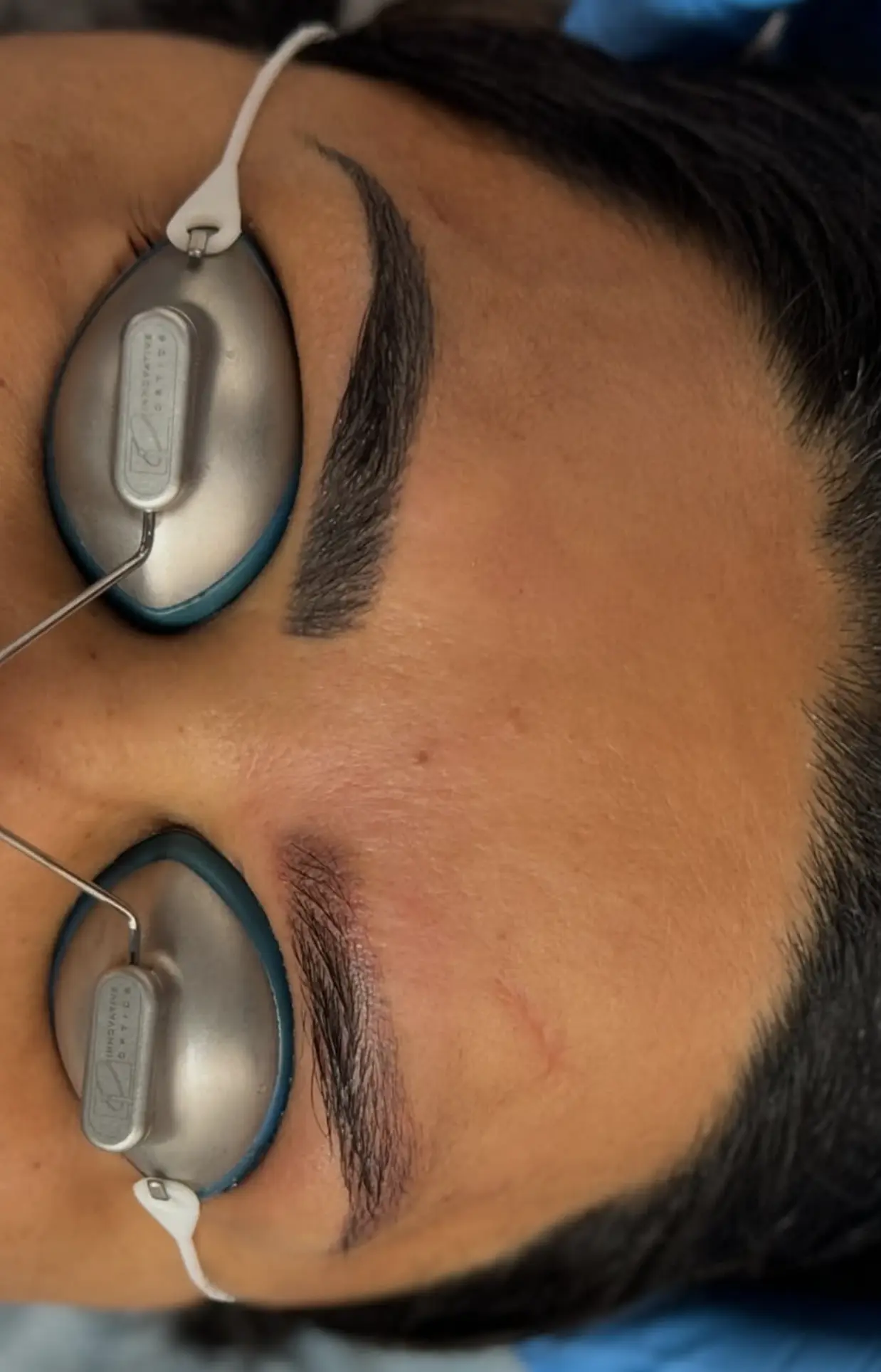 saline vs laser eyebrow tattoo removal
